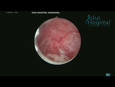 Miomectomía histeroscópica de los fibromas FIGO tipo 1 y 2