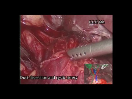 Laparoscopic Treatment of Winslow's Hiatus Hernia