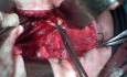 Excisión de Ganglios Linfáticos Pélvicos por Cáncer de Cuello Uterino
