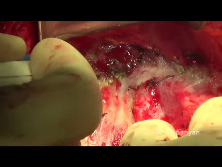 Cirugía citorreductora del cáncer de ovario. La extirpación del diafragma.