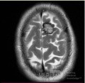 Estirpación de cavernoma subcortical 