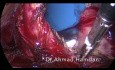 Histerectomía laparoscópica total con Ligasure