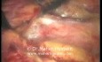 Disección de ganglios linfáticos paraaórticos - abordaje laparoscópico
