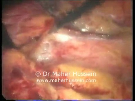 Disección de ganglios linfáticos paraaórticos - abordaje laparoscópico