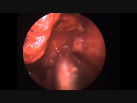 Escisión endoscópica de papiloma invertido
