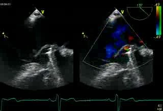 Regurgitación mitral