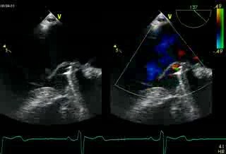 Regurgitación mitral