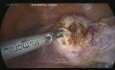 Histerectomía total por vía laparoscópica por un prolapso genital y pectopexia