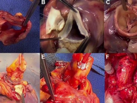 Trasplante de corazón usando el corazón tanto del donante como del receptor