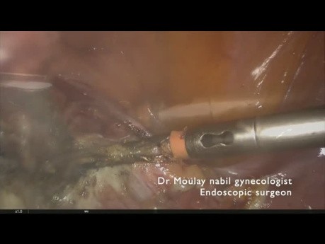 Histerectomía total laparoscópica ambulatoria con conservación ovárica