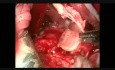 Extracción de Masa Ventricular Derecha y Reemplazo de Válvula Tricúspide