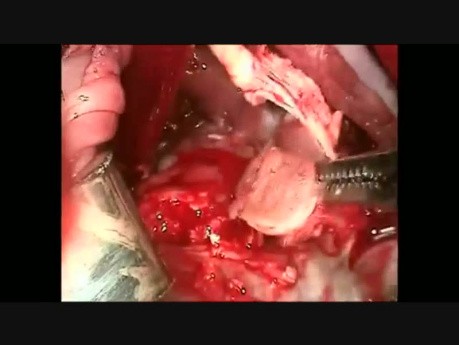 Extracción de Masa Ventricular Derecha y Reemplazo de Válvula Tricúspide