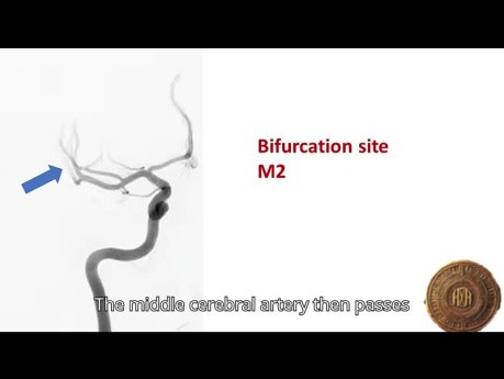 Ramas de la arteria cerebral media