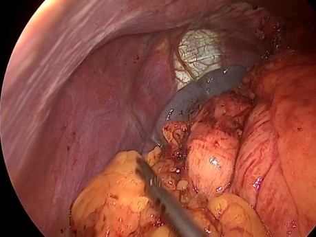 Cirugía antirreflujo en un paciente con situs inversus totalis