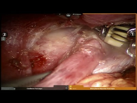 Teratoma mediastínico