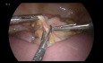 Laparoscopia en la obstrucción del intestino delgado