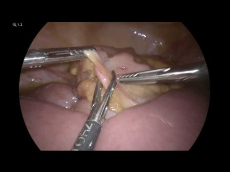 Laparoscopia en la obstrucción del intestino delgado