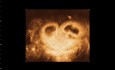 Imágenes en ginecología - ecografía 4D