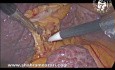 Colecistectomía laparoscópica en paciente cirrótico