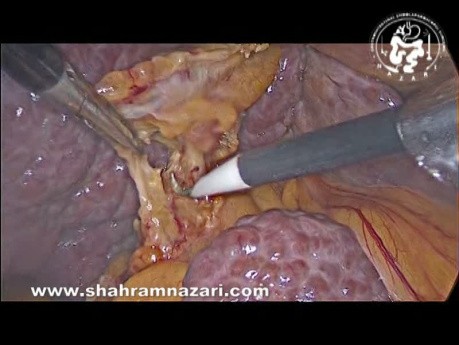 Colecistectomía laparoscópica en paciente cirrótico