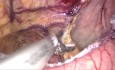 Bypass gástrico laparoscópico de una anastomosis (OAGB) con anastomosis cosida a mano