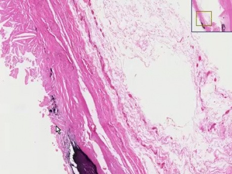 Ateroesclerosis - histopatología - aorta