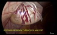 Endobag para cistectomía dermoidea