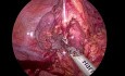 Bypass esofagogástrico laparoscópico del tracto digestivo superior mediante interposición colónica para estenosis esofágica y gástrica corrosiva.