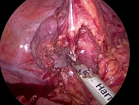 Bypass esofagogástrico laparoscópico del tracto digestivo superior mediante interposición colónica para estenosis esofágica y gástrica corrosiva.