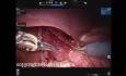 Kardiomiotomia metodą Hellera z użyciem robota