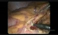 Hemicolectomía izquierda laparoscópica para el cáncer de colon obstruido