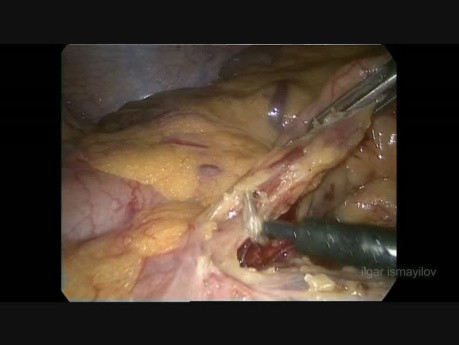 Hemicolectomía izquierda laparoscópica para el cáncer de colon obstruido