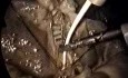 Cirugía Laparoscópica de Vesícula Biliar