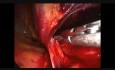 Reparación laparoscópica de una hernia inguinal con malla 3D MAX