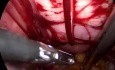 vNOTES Salpingooforectomía bilateral