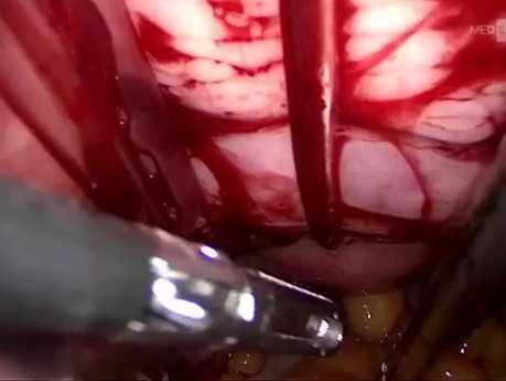 vNOTES Salpingooforectomía bilateral
