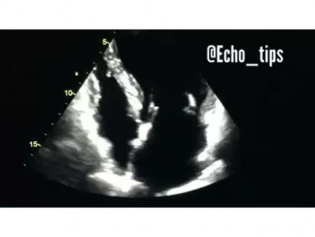 4. Caso de ecocardiografía - ¿Qué se ve?