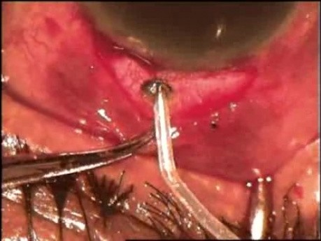 Cirugía de glaucoma neovascular