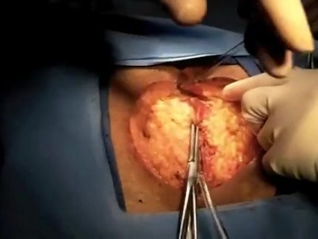 Resección abdominoperineal con sacrectomía con uso de robótica
