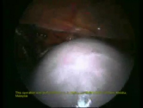Excisión total del útero - método laparoscópico