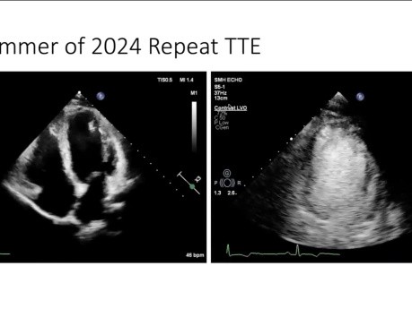 Más allá del ventrículo derecho: la miocarditis recurrente se desentraña como una miocardiopatía arritmogénica