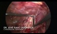 Resección laparoscópica de quiste peritoneal gigante