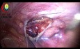 Reparación del arco muscular al tracto iliopúbico desde abajo hacia arriba