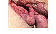 Gangrena Founier