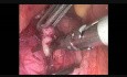 Cáncer de cuello uterino para recaída aórtica