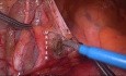 Resección abdominoperineal laparoscópica