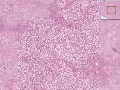 Esteatosis - histopatología - hígado