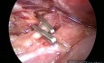 Colecistectomía laparoscópica en pancreatitis aguda posparto precoz