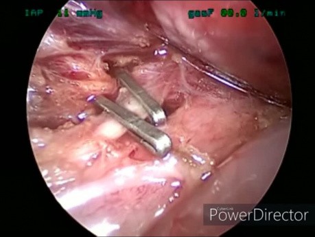 Colecistectomía laparoscópica en pancreatitis aguda posparto precoz