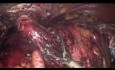 Degastro-gastrectomía por laparoscopia